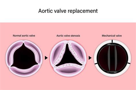 Penggantian Katup Aorta Katup Aorta Normal Stenosis Katup Aorta Katup Mekanis Perbaikan Katup ...