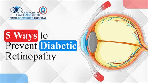 5 Steps To Safeguard Your Eyes From Diabetic Retinopathy