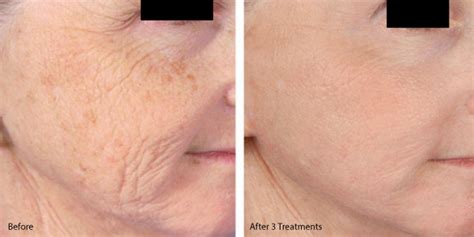 Can Micro Needling Help to Treat Pigmentation? - Micro Needle Pen