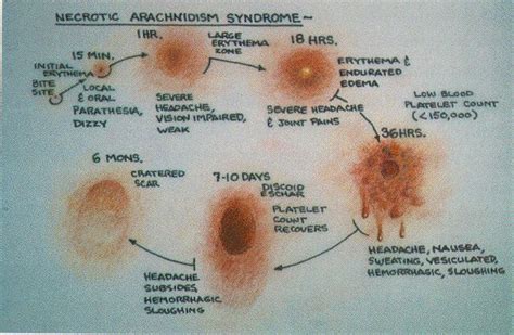 Life Cycle Of A Poisonous Spider Bite Brown Recluse Bite Stages Brown