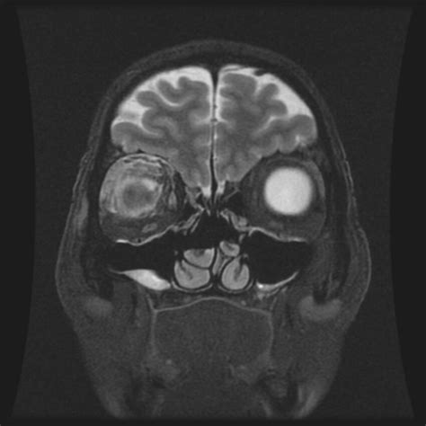 radiopaedia case orbital cellulitis id  study  nc commons