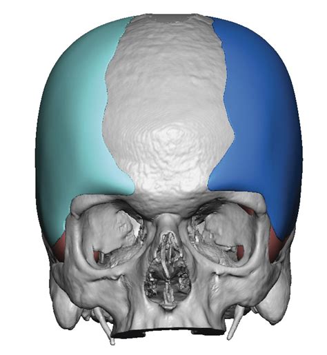 Plastic Surgery Case Study Custom Two Piece Skull Implant For Adult