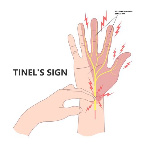 Carpal Tunnel Post Surgery Swelling