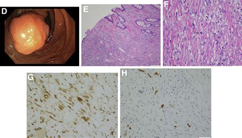 Atypical Colonic Polyp Gastroenterology