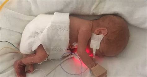 Tiny Twins Born Weighing 500 Grams And Born 14 Weeks Premature Are Home