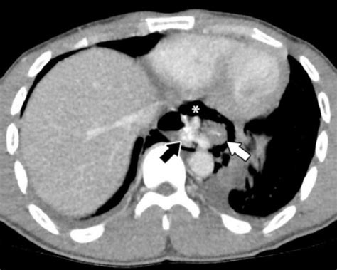 Perforación Esofágica Concise Medical Knowledge