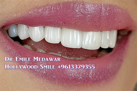 Hollywood Smile Procedure, Dentist Dr Emile Medawar, 00 961 3 379355: Perfect Dental Veneers for ...