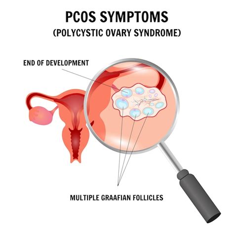 Premium Vector Pcos Symptoms Polycystic Ovary Syndrome Gynecology