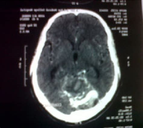 DSA image showing right MCA aneurysm | Download Scientific Diagram