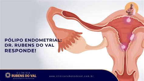 Pólipo endometrial Dr Rubens do Val responde Clínica Rubens do Val