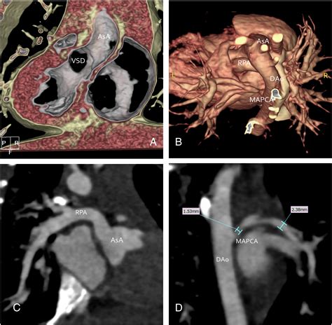 3d Mdct Angiography For The Preoperative Assessment Of Truncus Arteriosus Clinical Imaging