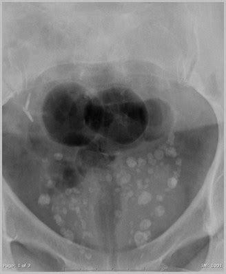 Soft Tissue Calcifications