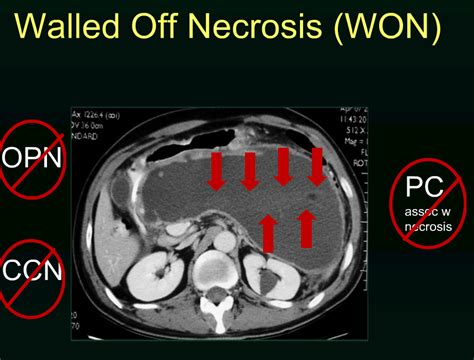 Rsna Acute Pancreatitis