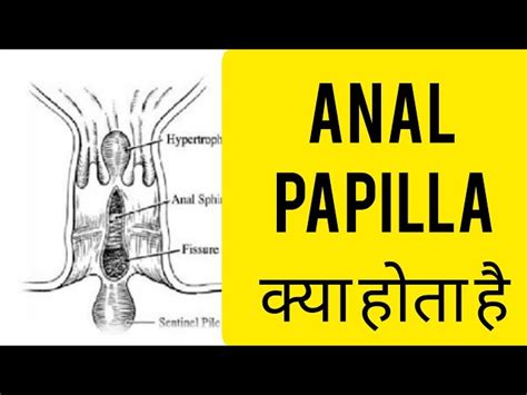 Anal Papillae