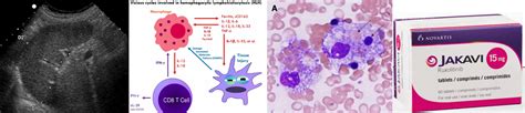 Hemophagocytic Lymphohistiocytosis Hlh Emcrit Project