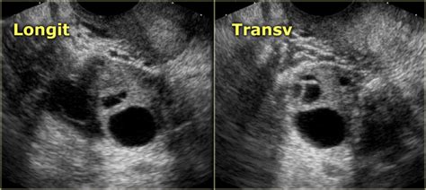 The Radiology Assistant Ovarian Cysts Common Lesions