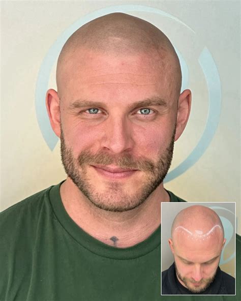 Mastering Hairline Design In Scalp Micropigmentation Tips And