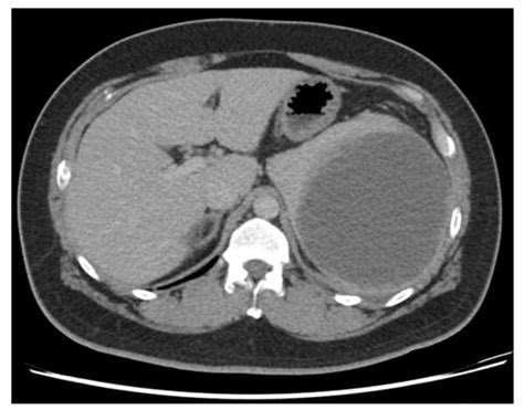 Diagnostics Free Full Text Unusual Rapid Growth Of Primary Splenic