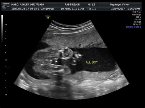 Help! Confusing gender reveal ultrasound! **Update at 20 weeks** - Page 3 - BabyCenter