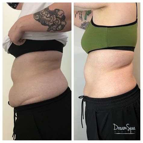 Body Contouring Before And After Photos Dream Spa Medical