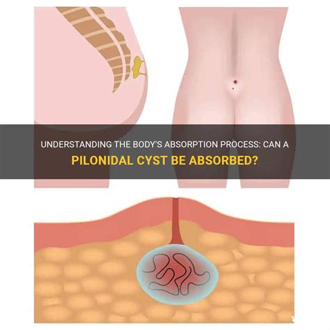 Understanding The Body S Absorption Process Can A Pilonidal Cyst Be Absorbed Medshun