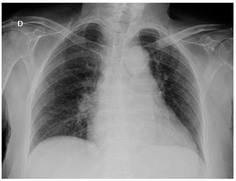 953 Miliary Tuberculosis In An Immunocompetent Child