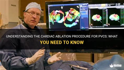 Understanding The Cardiac Ablation Procedure For Pvcs What You Need To Know Medshun