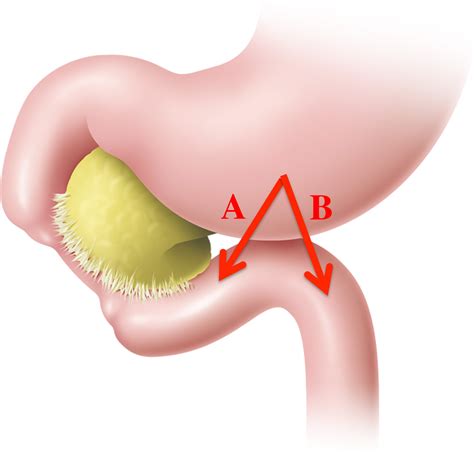 Loop Gastrojejunostomy