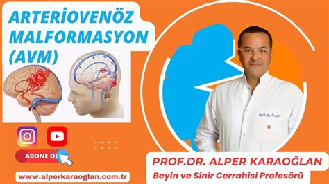 Arterioven Z Malformasyon Avm Damar Yuma Damar Yumaklanmas Nedir