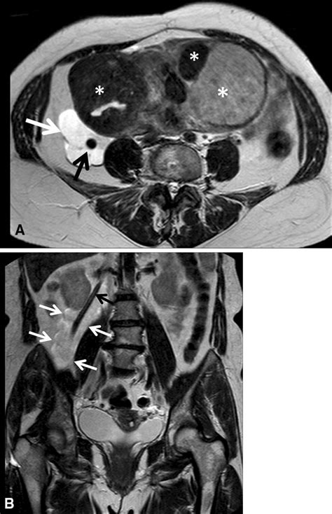 A 48-year-old woman with abdominal distention. T2-weighted images in ...