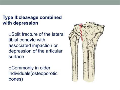 Tibial Plateau Fractures Ppt