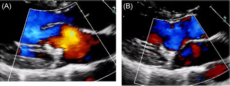 Transthoracic Echocardiography The Anterior Leaflet Is Long A But