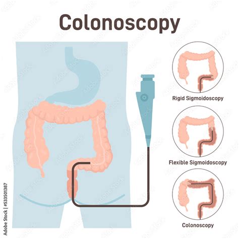 Colonoscopy Medical Diagnostics Of The Large Intestine