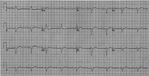 The 12 Lead Resting Electrocardiogram Ecg Showing Normal Sinus Rhythm