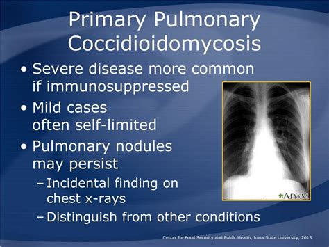 Ppt Coccidioidomycosis Powerpoint Presentation Free Download Id407318