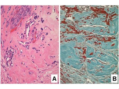 Lymphangioma Like Kaposi Sarcoma Seen At Higher Magnification In Which