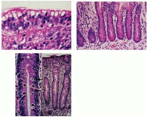 Small Bowel Mucosal Disease Abdominal Key