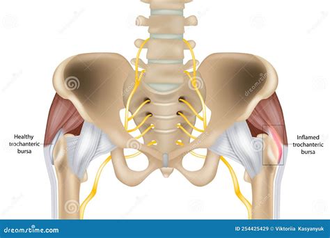 Hip Trochanteric Bursitis is Inflammation of the Bursa. Healthy and Inflamed Trochanteric Bursa ...