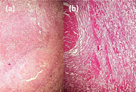 A Polymorphous Suppurated Inflammatory Infiltrate ×40 B Download Scientific Diagram