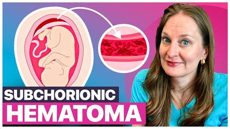 Subchorionic Hematoma And Bleeding In Pregnancy What To Expect And How