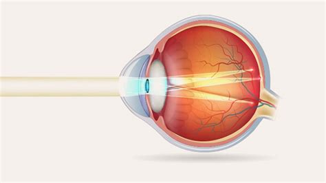 Why does astigmatism affect our night vision?