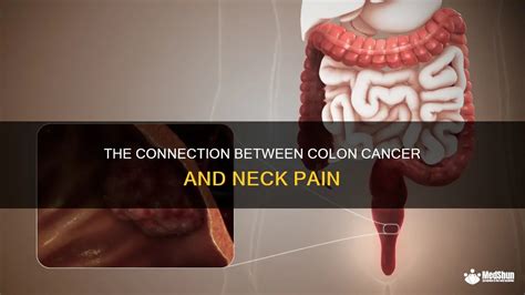 The Connection Between Colon Cancer And Neck Pain Medshun