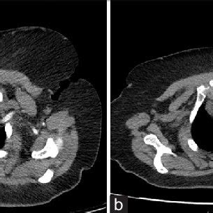 Contrast Enhanced Computed Tomography Scan Of The Head And Neck With