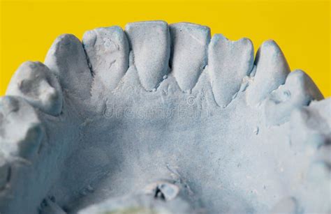 Blue Plaster Impression Of A Patient S Dental Jaw With Crooked Teeth