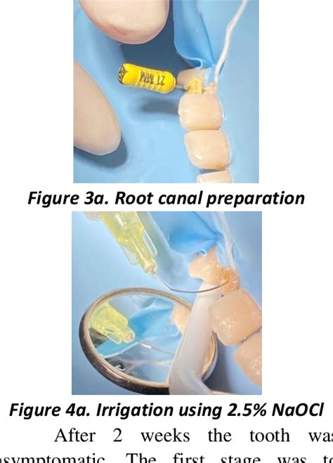 Figure 4 From Bone Regeneration On Chronic Apical Abscess After Root Canal Treatment Semantic