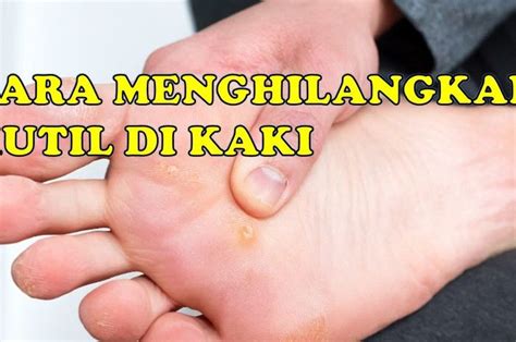 Cara Mudah Mengobati Kutil Di Telapak Kaki Tanpa Harus Operasi Grid Health