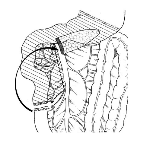 After omentectomy and right colon mobilization – Kocher monoeuvre ...