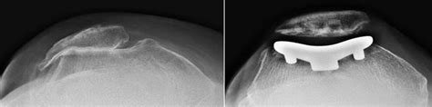 Patellofemoral Replacement - OrthoInfo - AAOS