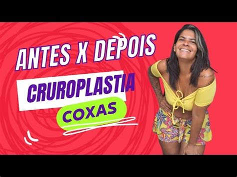 Antes E Depois Da Cruroplastia Cirurgia Pl Stica Nas Coxas Youtube