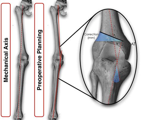 Supplemental Materials For Varus Producing Lateral Distal Femoral